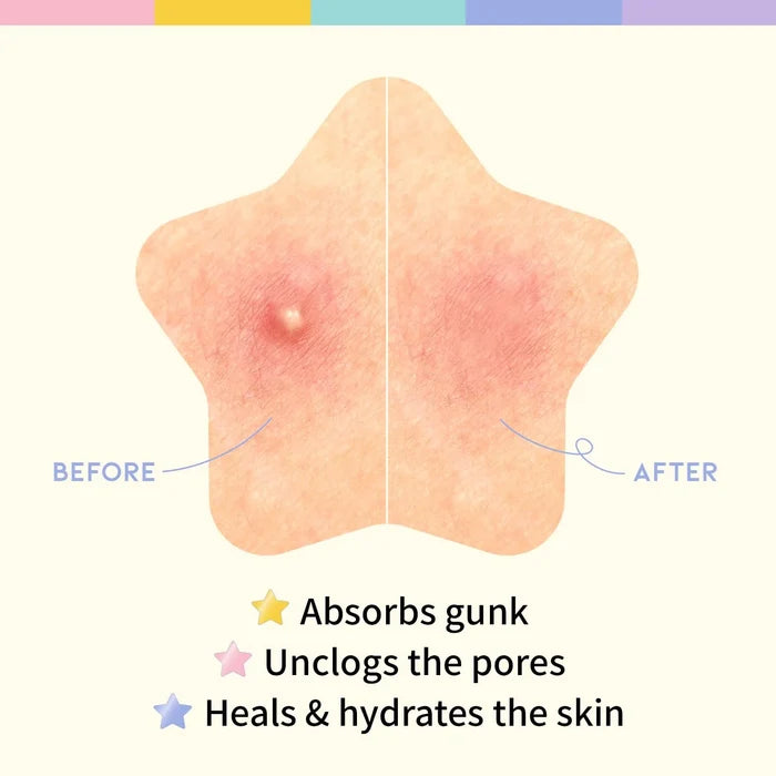 #OOTD - Brightening Acne Spot Patch